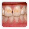Stained / discoloured teeth