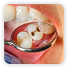 Holes In Teeth